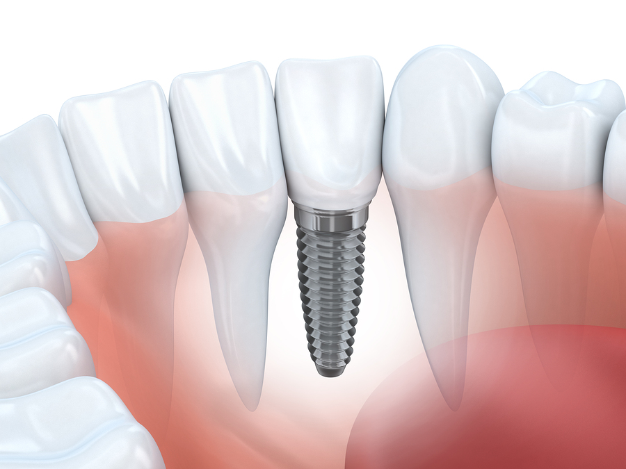 Vancouver Dental implants